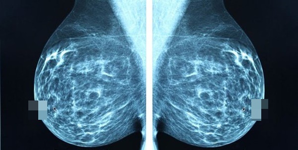 Có 7 yếu tố này trong cuộc sống, bạn có nguy cơ bị ung thư vú cao hơn-1