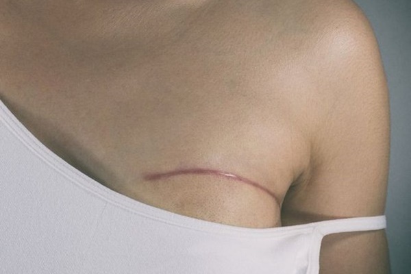 Âm thầm như ung thư thận-2