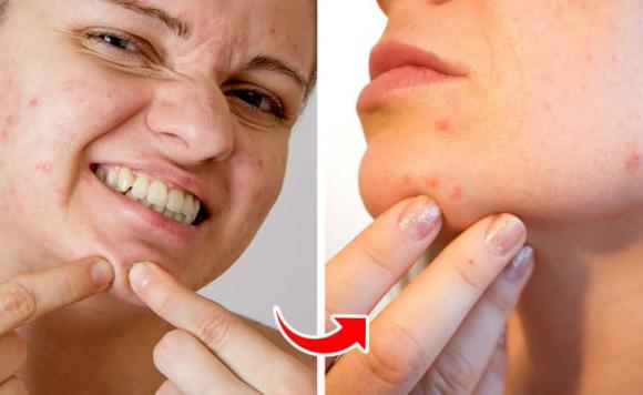 Làm thế nào để thoát khỏi mụn đầu đen ở cằm một lần và mãi mãi-6