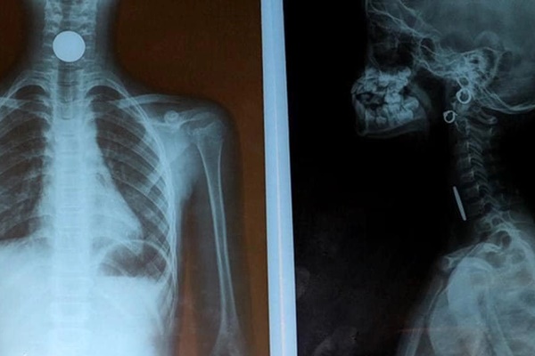 2 việc cần làm ngay khi trẻ bị hóc dị vật-1