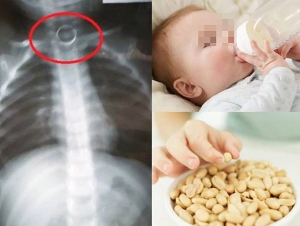 2 việc cần làm ngay khi trẻ bị hóc dị vật-3