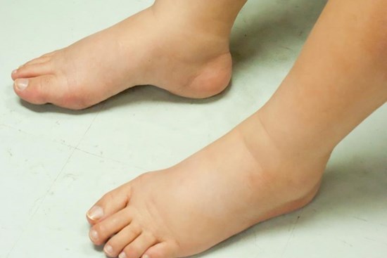 10 dấu hiệu sớm của bệnh suy thận