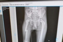 Xác minh clip cháu bé bị mẹ đạp gãy xương đùi-1