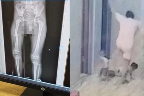 Hoàn cảnh gia đình bé trai bị mẹ đạp gãy xương đùi