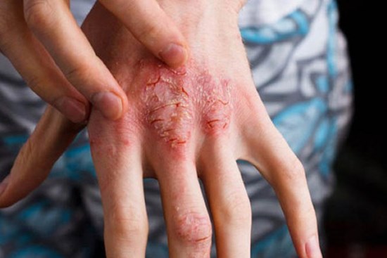 Hơn 5 triệu người Việt mắc tiểu đường: 5 dấu hiệu chứng tỏ đường huyết đang tăng