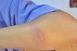 Thầy giáo ở Nghệ An đánh bầm tay nữ sinh