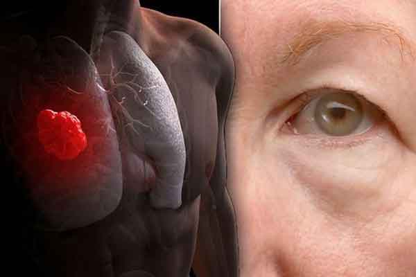 Phát hiện ung thư phổi sau 1 tháng ho vặt, tức ngực, dấu hiệu chỉ ra bệnh hiểm-2