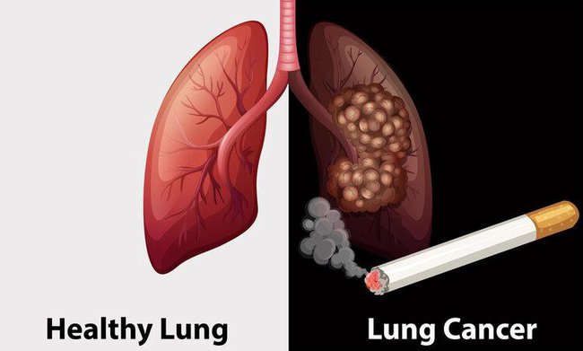 Nếu có 4 dấu hiệu bất thường ở đầu, hãy cảnh giác sự xuất hiện của ung thư phổi-2