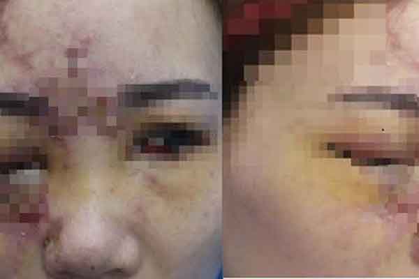Bác sĩ thẩm mỹ cảnh báo biến chứng do cấy chỉ mũi và tiêm filler nâng mũi-2