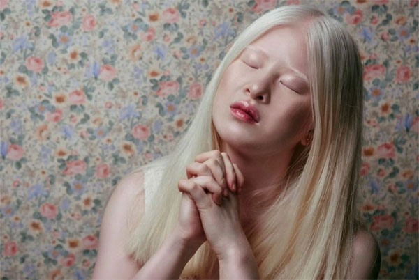 Cô bé bạch tạng khiến hàng triệu người Trung Quốc xúc động-3