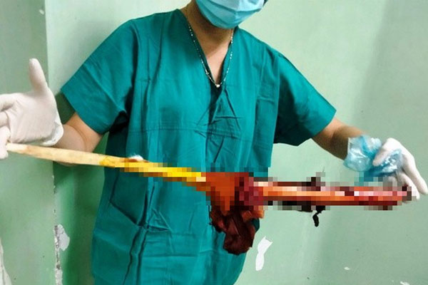 Ớn lạnh người đàn ông bị cây gỗ đâm xuyên từ trước ngực ra sau lưng-1