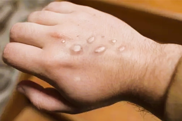 6 khuyến cáo phòng chống bệnh đậu mùa khỉ-3