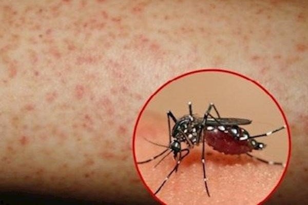 Người đàn ông 40 tuổi đau đầu dữ dội, chảy máu ồ ạt sau 3 ngày mắc sốt xuất huyết-1