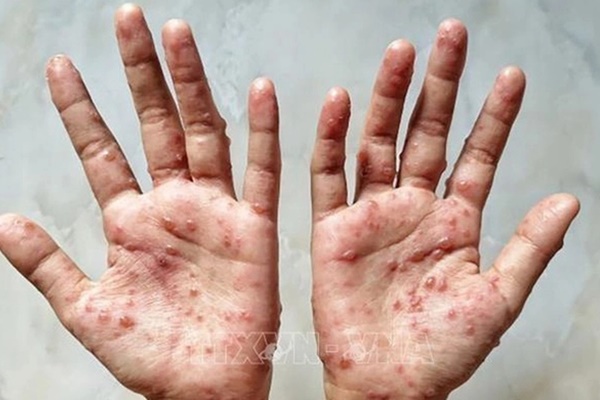 6 khuyến cáo phòng chống bệnh đậu mùa khỉ-1