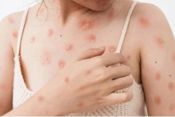 Sức khoẻ bệnh nhân mắc đậu mùa khỉ đầu tiên tại Việt Nam hiện ra sao?-2