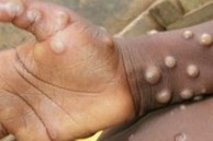 Sức khoẻ bệnh nhân mắc đậu mùa khỉ đầu tiên tại Việt Nam hiện ra sao?