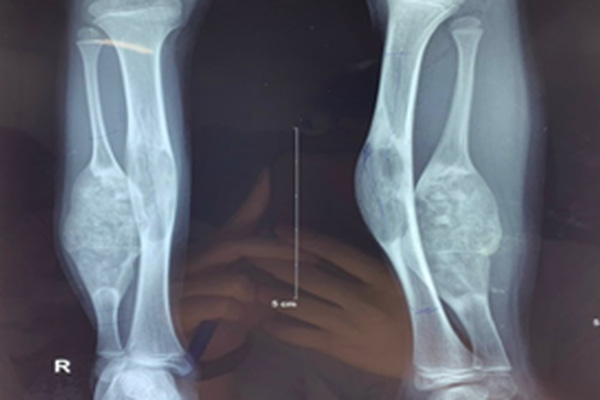 Hiếm gặp: Cẳng chân bé gái bị biến dạng do loạn sản xơ xương-1