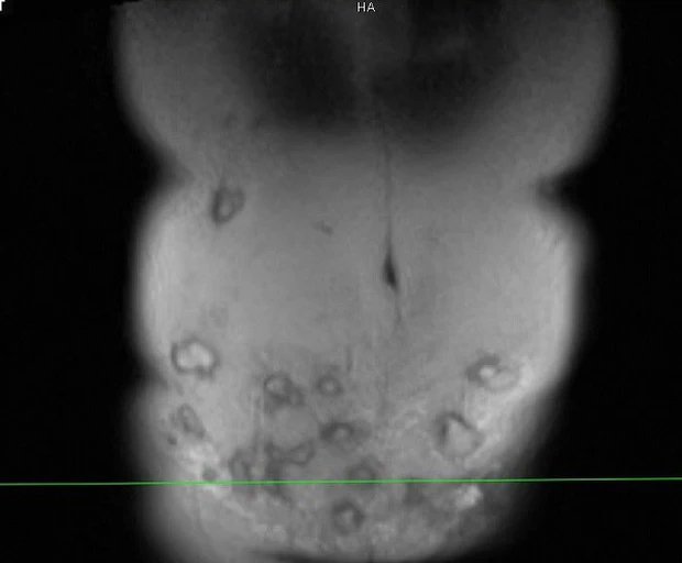 Vợ giấu chồng đi đánh mỡ bụng, một tháng sau vào viện với vài chục ổ áp xe to như quả táo-2