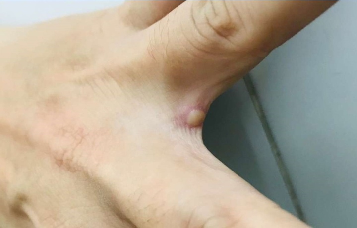 Hình ảnh bóng nước ở bệnh nhân mắc đậu mùa khỉ đầu tiên tại Việt Nam-1