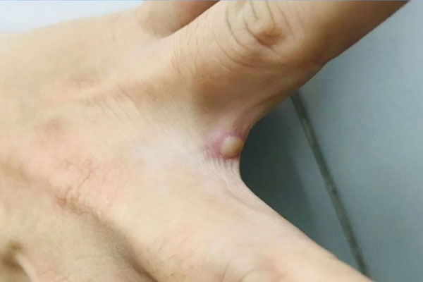 Đậu mùa khỉ có phải là bệnh lây truyền qua đường tình dục?-2