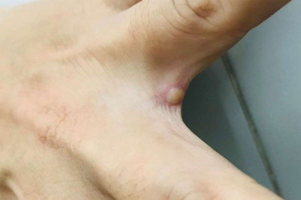 Vết mụn nước ở ca mắc đậu mùa khỉ tại Việt Nam có nguy hiểm? Chuyên gia người Việt tại Đức lý giải-3