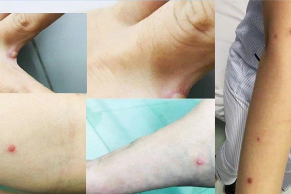 HCDC cảnh báo nguy cơ phát hiện thêm ca đậu mùa khỉ ở TP.HCM-2