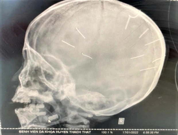 Vụ đóng 9 chiếc đinh vào đầu bé gái: 5 lần ra tay tàn độc của bố dượng-2