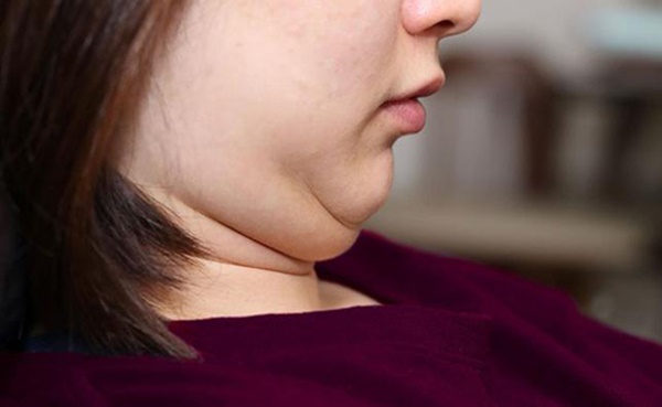 Đoán bệnh qua vị trí mỡ thừa ở từng vùng trên cơ thể của bạn-2