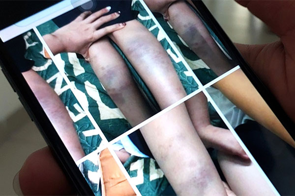 Mới nhất vụ học sinh bị đánh bầm tím ở trường: Hai người mẹ nói... vô lý-4
