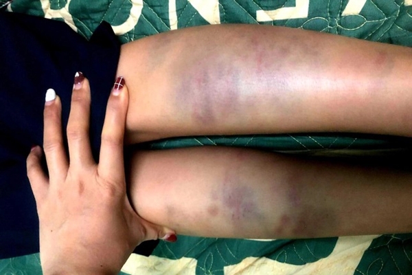 Đà Nẵng: Học sinh lớp 1 bị bạn đánh bầm tím chân, đề nghị kỷ luật giáo viên chủ nhiệm-3