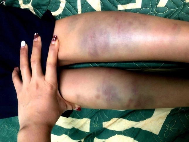Đà Nẵng: Học sinh lớp 1 bị bạn đánh bầm tím chân, đề nghị kỷ luật giáo viên chủ nhiệm-1