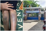 Đà Nẵng: Học sinh lớp 1 bị bạn đánh bầm tím chân, đề nghị kỷ luật giáo viên chủ nhiệm