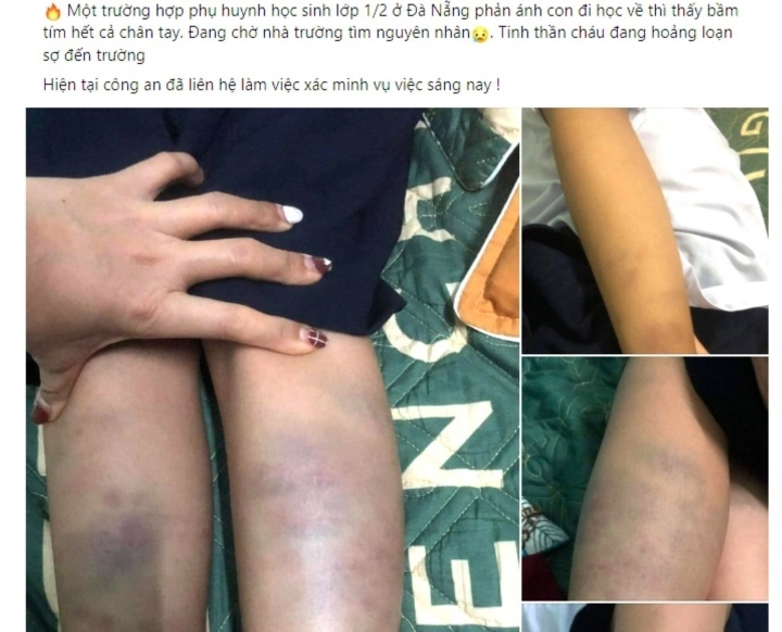 Học sinh lớp 1 bị đánh bầm tím chân tay: Công an TP Đà Nẵng vào cuộc-1