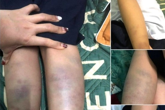 Học sinh lớp 1 bị đánh bầm tím chân tay: Công an TP Đà Nẵng vào cuộc