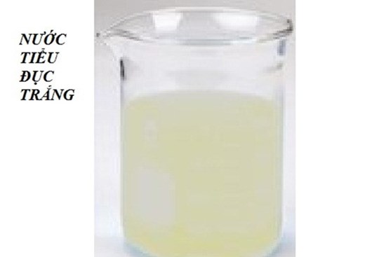 Nước tiểu trắng đục như sữa do loại ký sinh trùng có thể ở trong người hàng chục năm