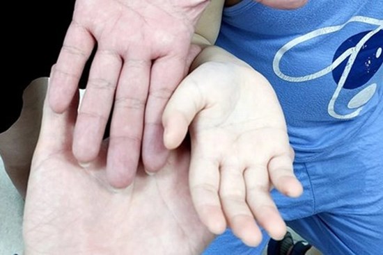 Bé trai mũm mĩm nhưng hay ốm, có bàn tay trắng toát khác thường: Bác sĩ chỉ ra nguyên nhân