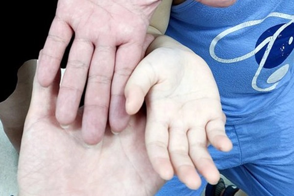 Bé trai mũm mĩm nhưng hay ốm, có bàn tay trắng toát khác thường: Bác sĩ chỉ ra nguyên nhân-1