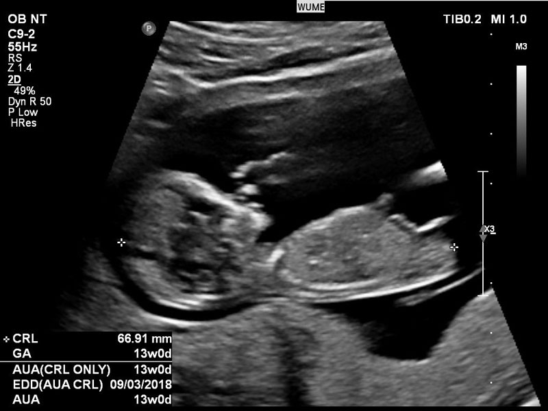 Ý nghĩa của các chỉ số thai nhi khi siêu âm mẹ bầu cần biết-2
