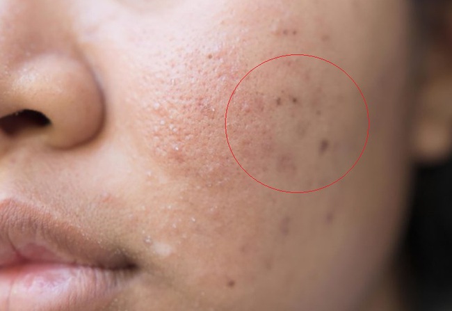 Sẹo rỗ sau mụn: 2 cách đơn giản trị sẹo, tăng sinh collagen được bác sĩ da liễu khuyên dùng-1