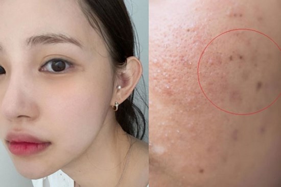 Sẹo rỗ sau mụn: 2 cách đơn giản trị sẹo, tăng sinh collagen được bác sĩ da liễu khuyên dùng