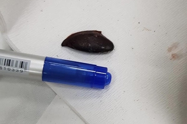 Clip: Bác sĩ tá hỏa phát hiện 6 con nhện làm tổ trong tai người phụ nữ-1