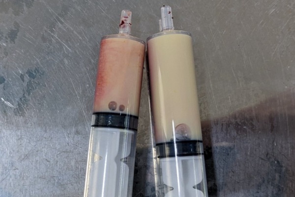 Máu đục như sữa, người phụ nữ suýt tử vong vì viêm tụy cấp-2