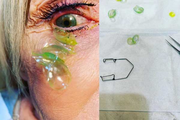 Bác sĩ Mỹ tháo 23 kính áp tròng bệnh nhân để quên trong mắt-1