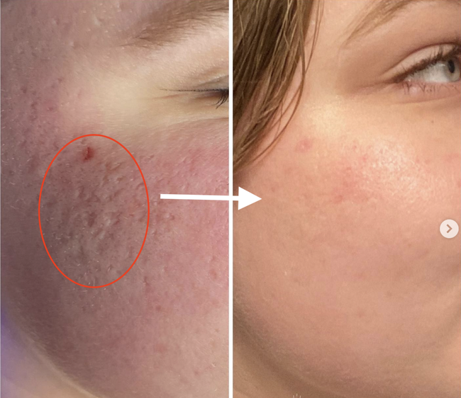 Tăng sinh collagen cho làn da theo lời khuyên của chuyên gia da liễu-2