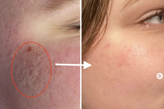 Tăng sinh collagen cho làn da theo lời khuyên của chuyên gia da liễu