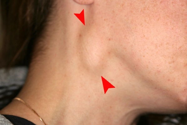 Triệu chứng không ngờ cảnh báo bệnh ung thư vòm mũi họng-1