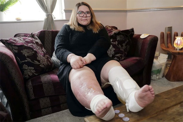 Người phụ nữ gặp nguy hiểm sau khi bị côn trùng cắn 5 năm trước-1