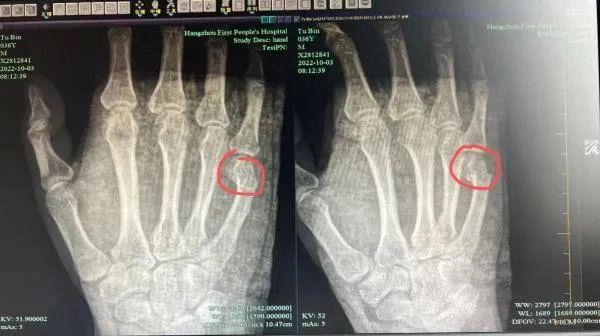 Bố gãy tay vì kèm con làm bài tập về nhà-2