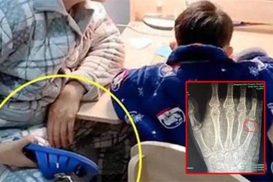 Bố gãy tay vì kèm con làm bài tập về nhà