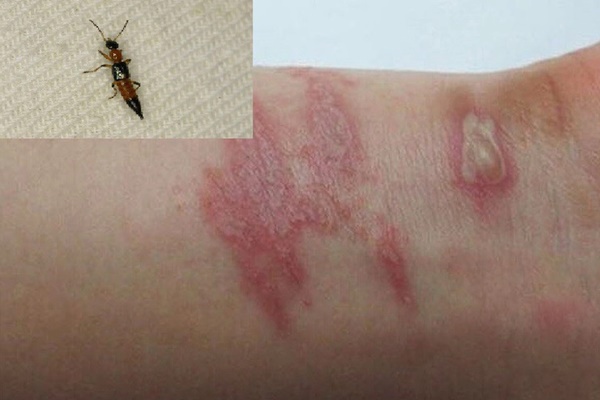Cách xử trí khi bị kiến ba khoang đốt-4
